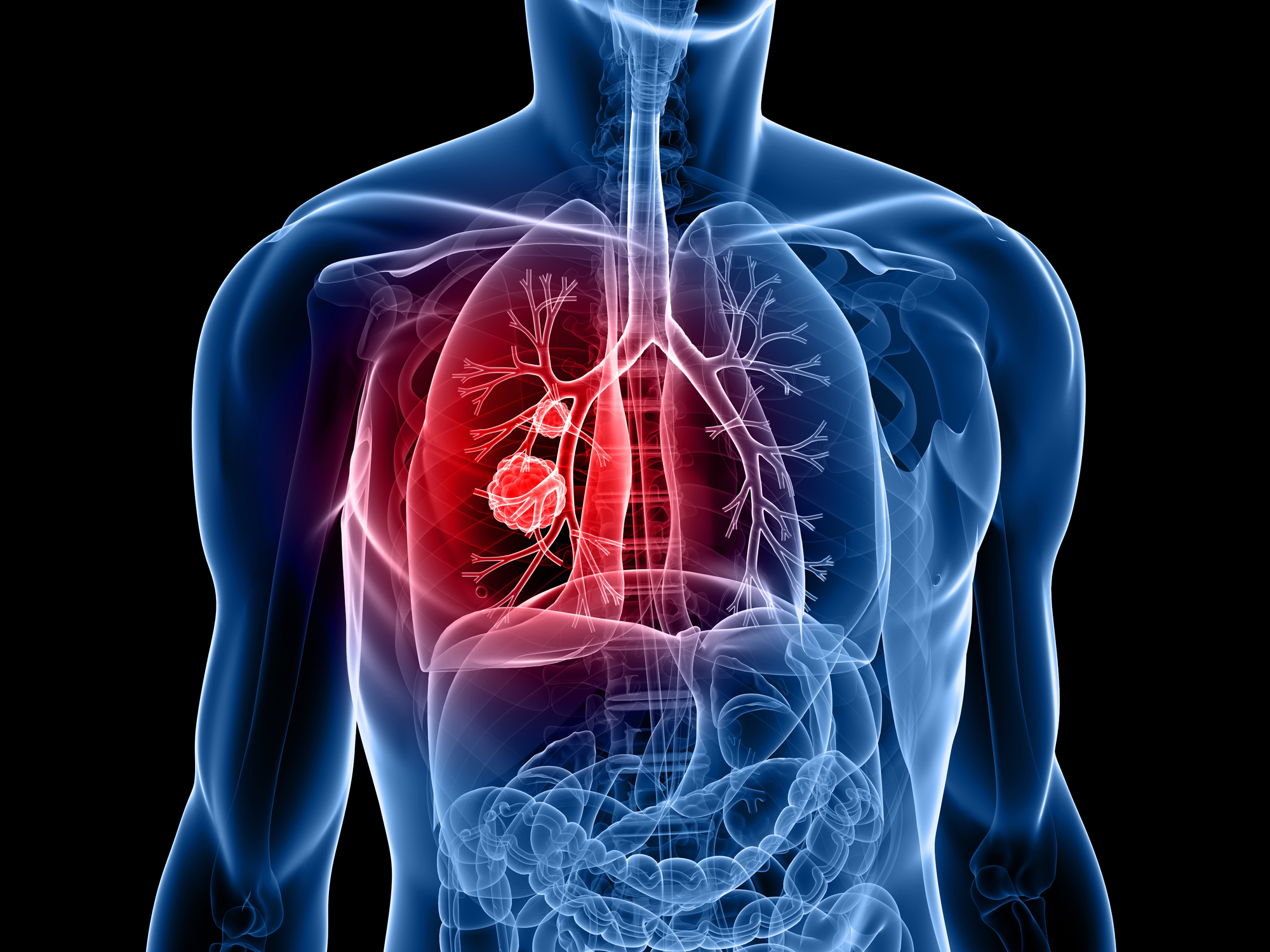 Cancer du poumon métastatique : une thérapie ciblée pour améliorer ...