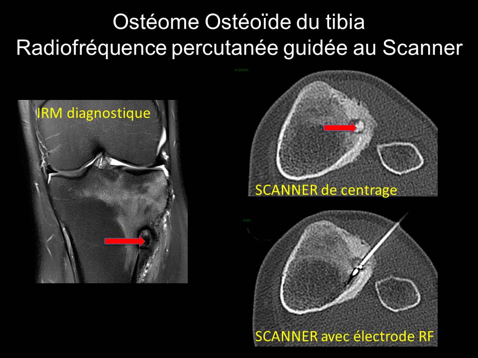 Ostéome Ostéoïde du tibia