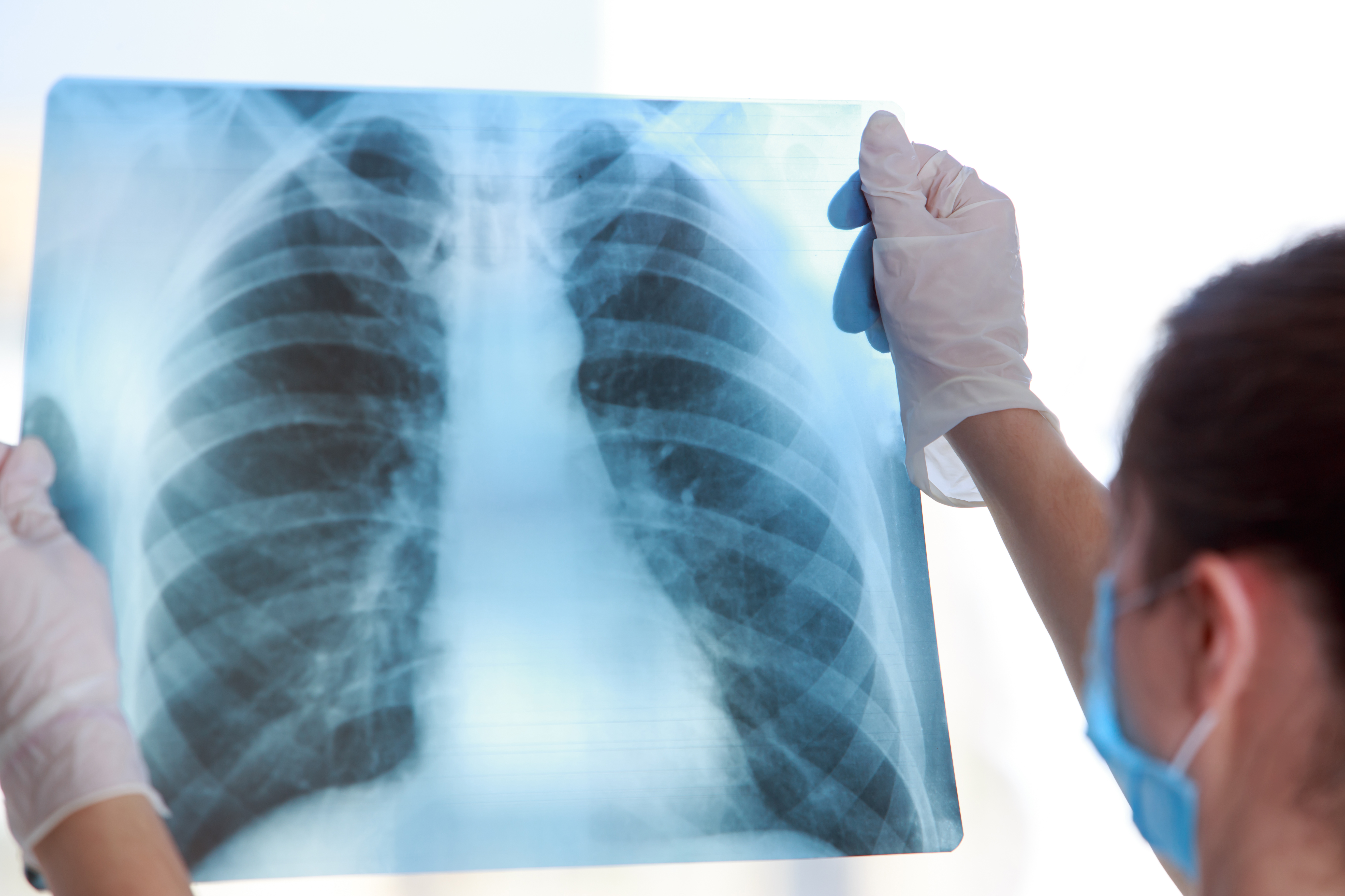 Dépistage du cancer du poumon par scanner faible dose 