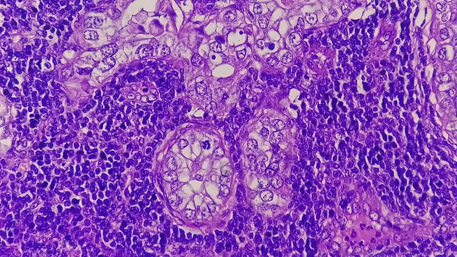 Adénocarcinome de l’estomac, vue microscopique