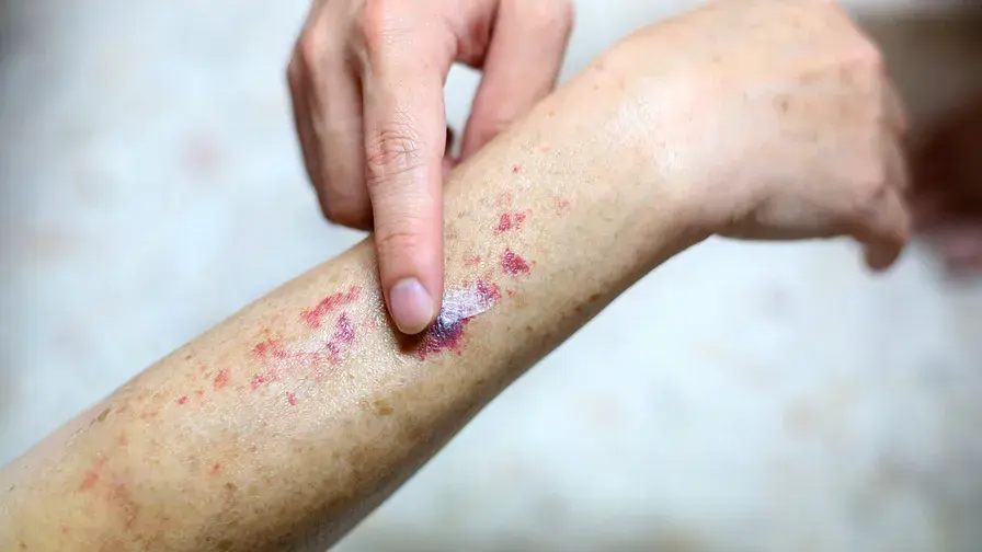 Une étude nationale sur la thrombopénie immunologique