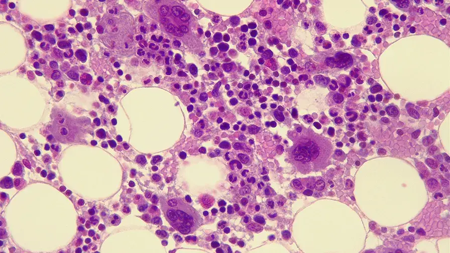 Allogreffe de cellules souches hématopoïétiques et lymphomes T cutanés