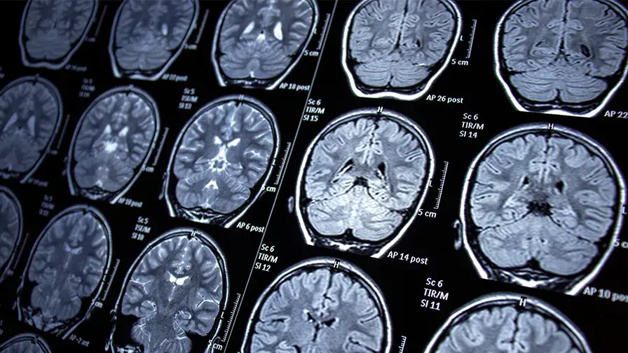 Un nouveau candidat-médicament ralentit la progression de l’adrénoleucodystrophie  