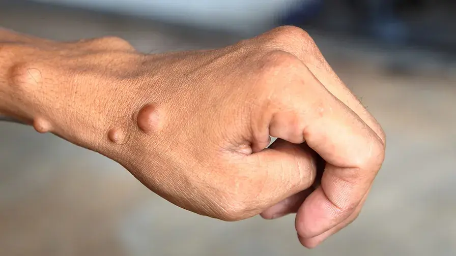 ComPaRe Neurofibromatose