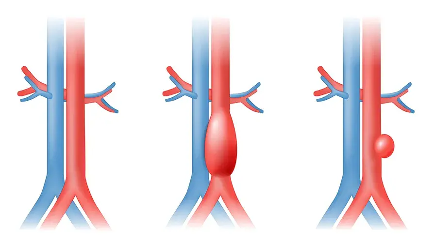 Première pose d’endoprothèse aortique en ambulatoire à l’hôpital Ambroise Paré