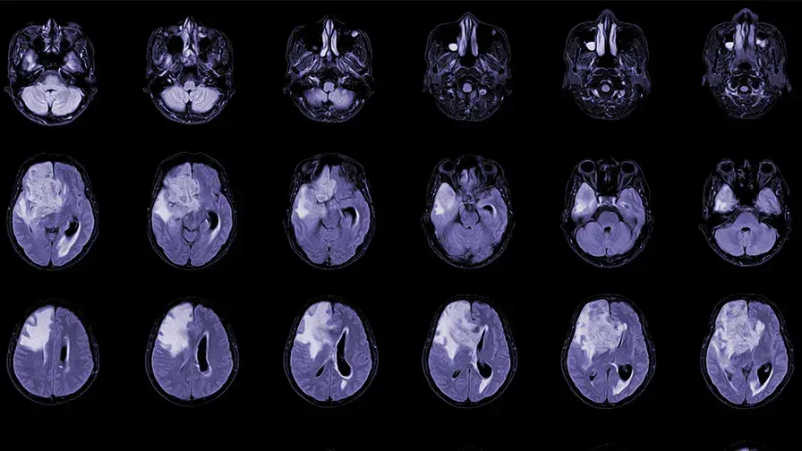 IRM,vues axiales du cerveau
