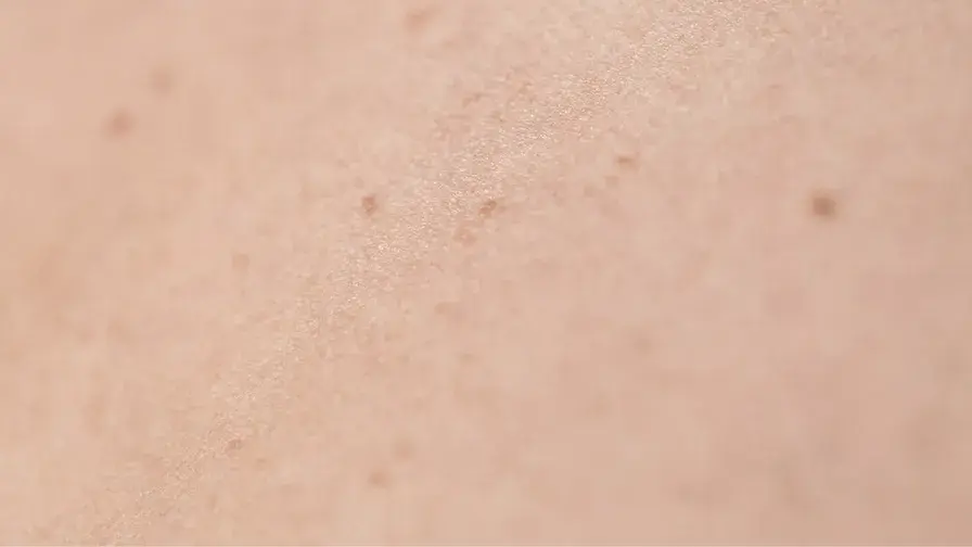 infections nécrosantes de la peau et des parties molles