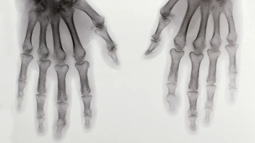 Polyarthrite_rhumatoide