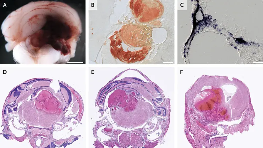 rôle majeur des mutations du gène PIK3CA dans les cavernomes sporadiques