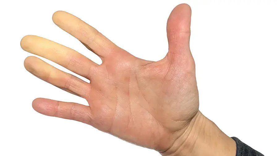 Main avec le syndrome de Raynaud, le phénomène de Raynaud ou les maladies de Raynaud