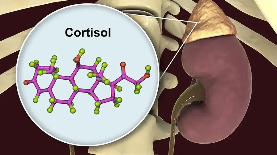 Hyperplasie bilatérale macronodulaire des surrénales avec syndrome de Cushing