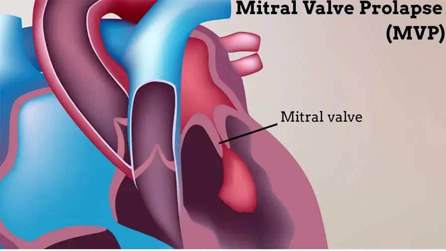 Valve mitrale