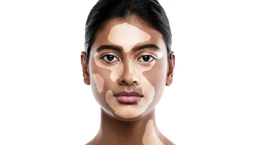 Vitiligo